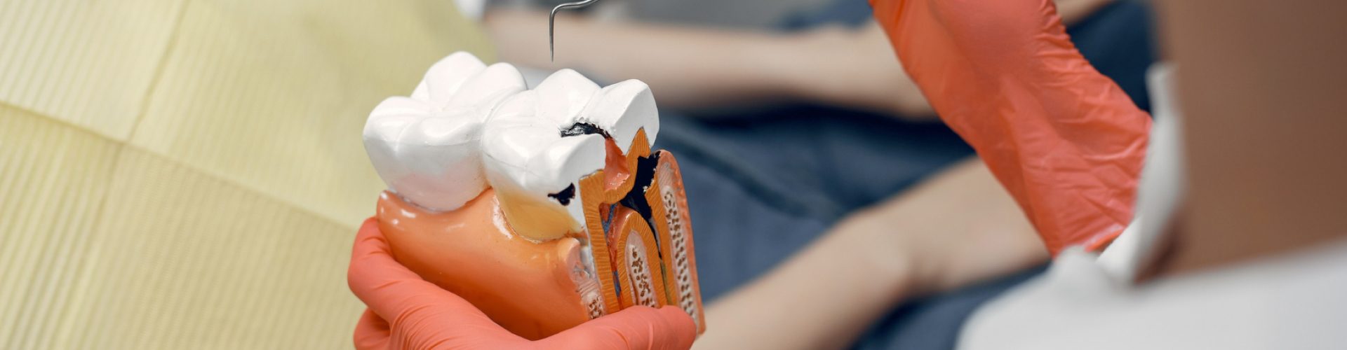 Close-up of a dental model with a tooth cavity, as a dentist points to the decay with a dental instrument to explain how a cavity filling restores the tooth.